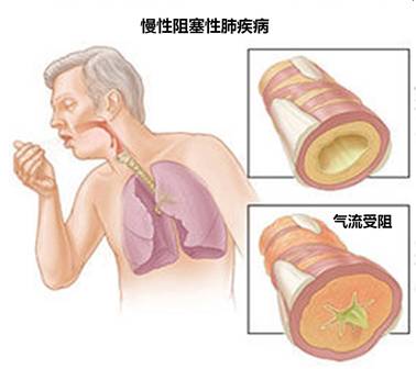 COPD-03.jpg