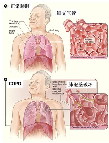 COPD-01.jpg