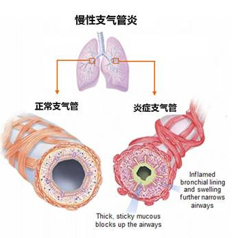 COPD-02.jpg