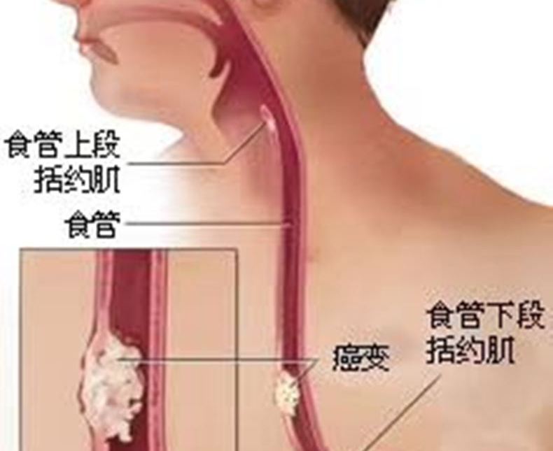 食道癌-002.jpg