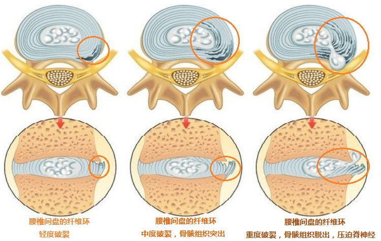 日本dst治疗-腰椎纤维环再生修复疗法