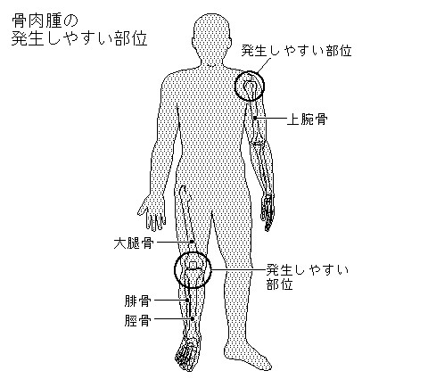 何谓骨肉瘤骨骼不仅能够支撑人的身体保护脏器,还能储存钙和磷等,并在