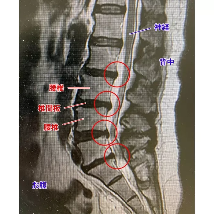 【dst案例分享】印度尼西亚患者来院治疗腰痛·坐骨神经痛 - 传祺国际