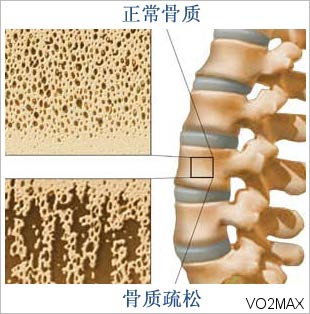 骨质疏松症是由代谢性骨病变(骨吸收与骨形成失衡)引起的一组骨病