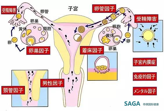 【女性不孕不育】在日本的诊断和治疗方法 - 传祺国际健康