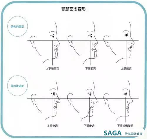 【偏颌畸形】在日本的诊断和治疗方法 - 传祺国际健康