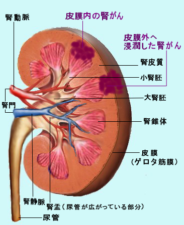 肾癌日本的诊断和治疗介绍