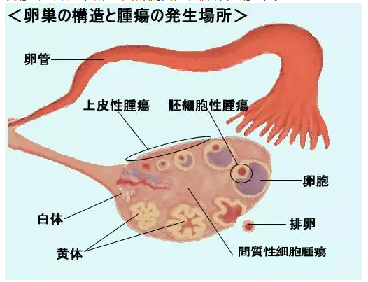 【卵巢癌】日本的诊断和治疗介绍