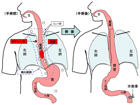 气管与食道的位置图图片